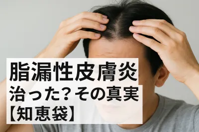 脂漏性皮膚炎 治った？その真実【知恵袋】