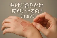 やけど治りかけ皮がむけるの？【知恵袋】