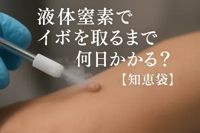 液体窒素でイボを取るまで何日かかる？【知恵袋】
