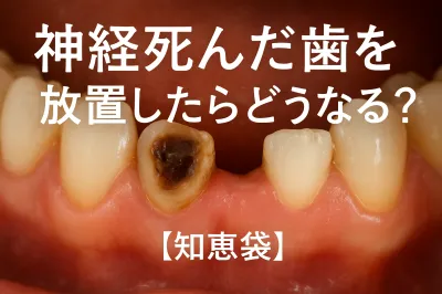 神経死んだ歯を放置したらどうなる？【知恵袋】