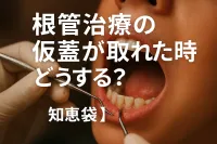 根管治療の仮蓋が取れた時どうする？【知恵袋】