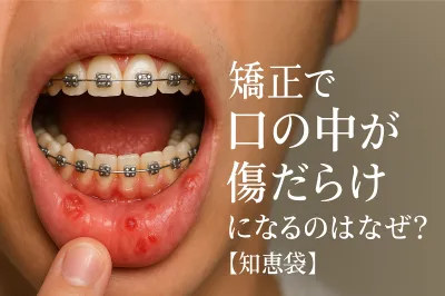 矯正で口の中が傷だらけになるのはなぜ？【知恵袋】