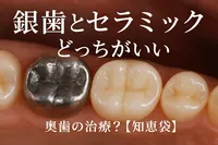 銀歯とセラミックどっちがいい奥歯の治療？【知恵袋】