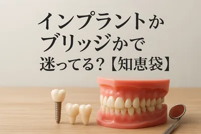 インプラントかブリッジかで迷ってる？【知恵袋】