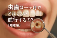 虫歯は一ヶ月でどれくらい進行するの？【知恵袋】