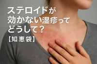 ステロイドが効かない湿疹ってどうして？【知恵袋】
