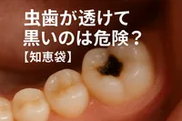 虫歯が透けて黒いのは危険？【知恵袋】