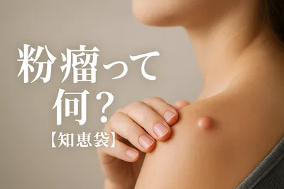 粉瘤って何？【知恵袋】
